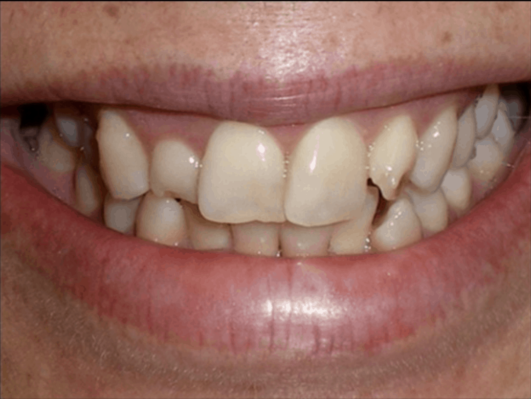 before dental veneers