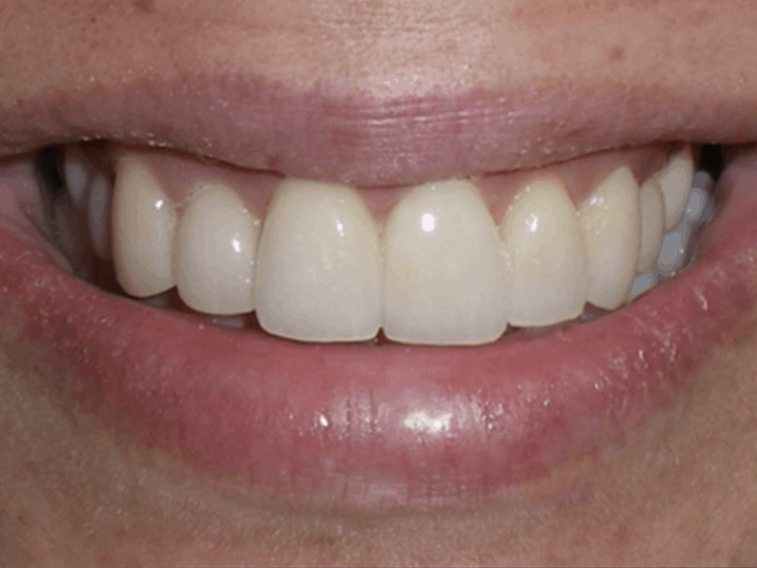 after dental veneers