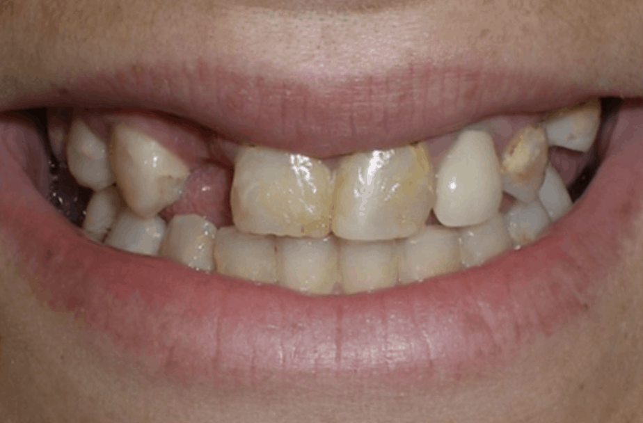 before dental bridge placement danbury ct