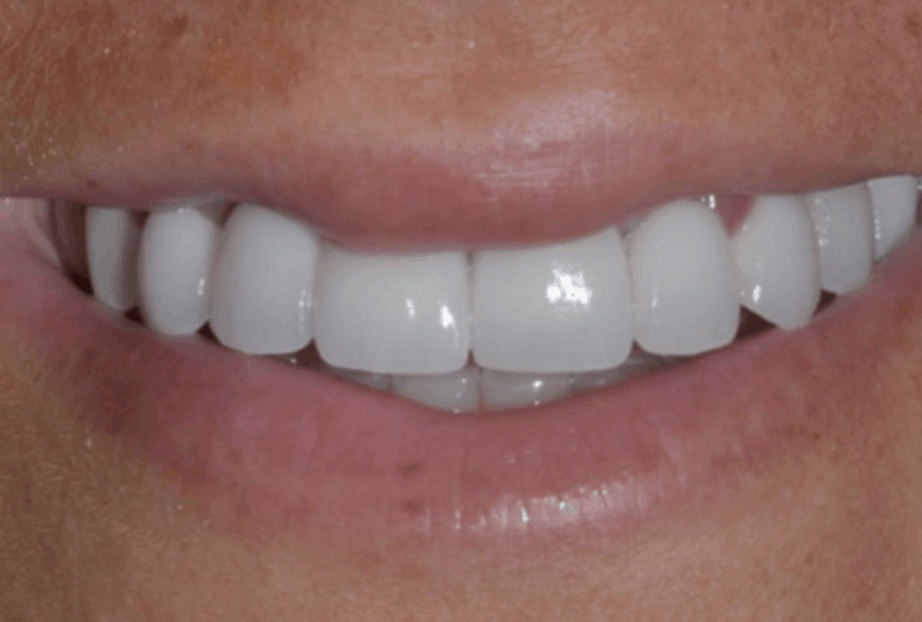 full arch dental bridge danbury