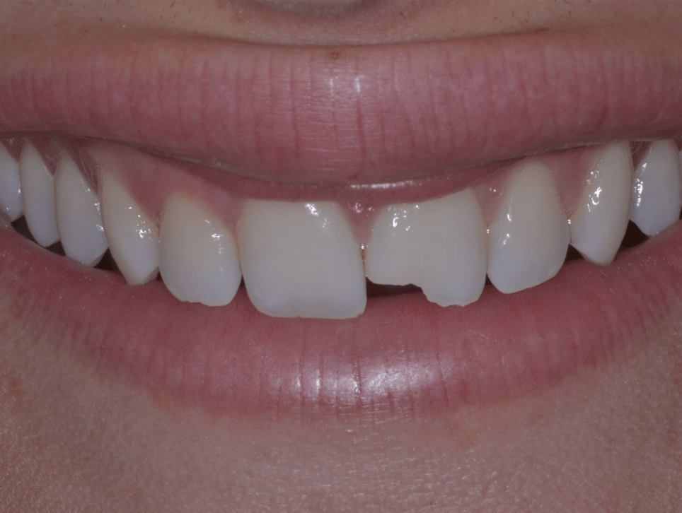 dental composite danbury ct