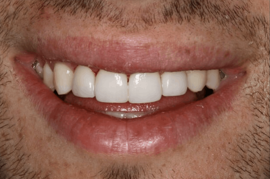 emax dental veneers danbury