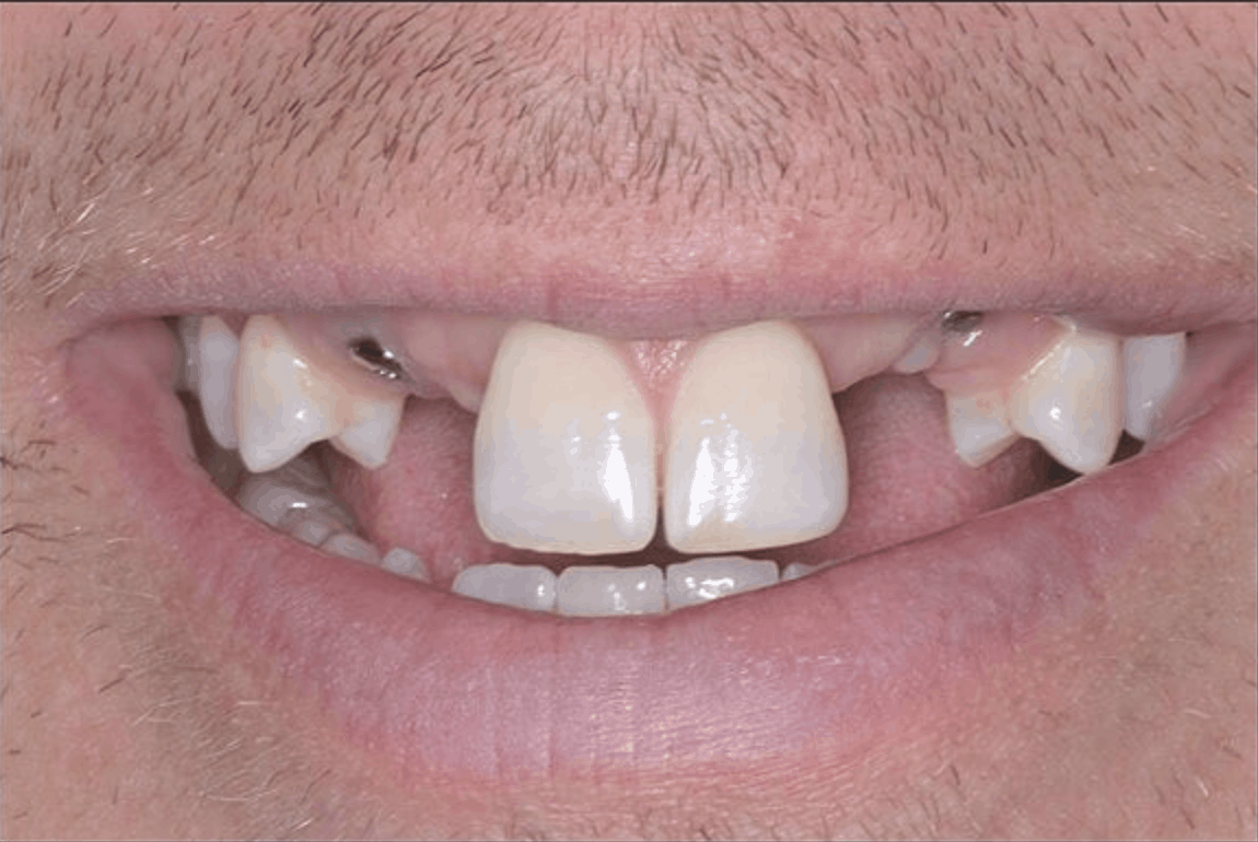 before dental implant crowns danbury