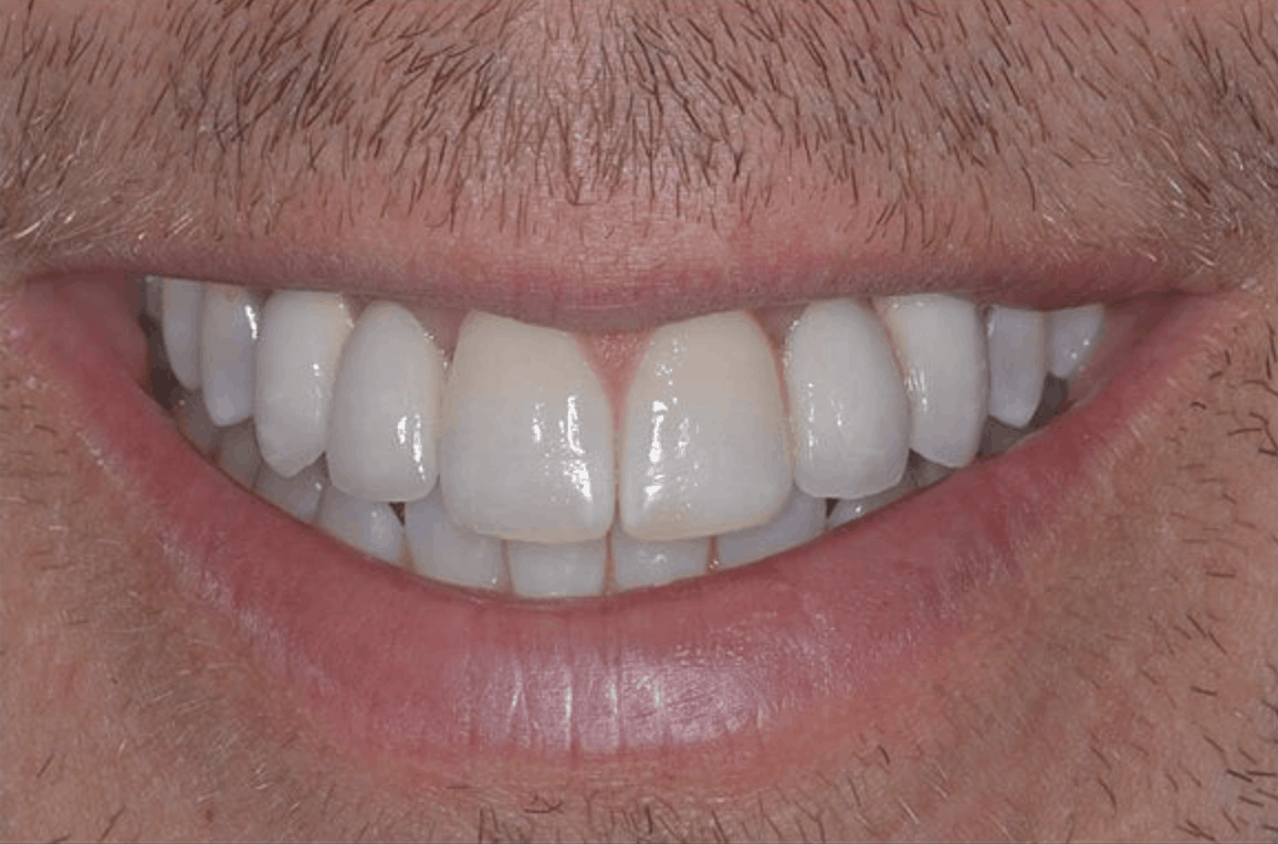 after dental implant crowns danbury