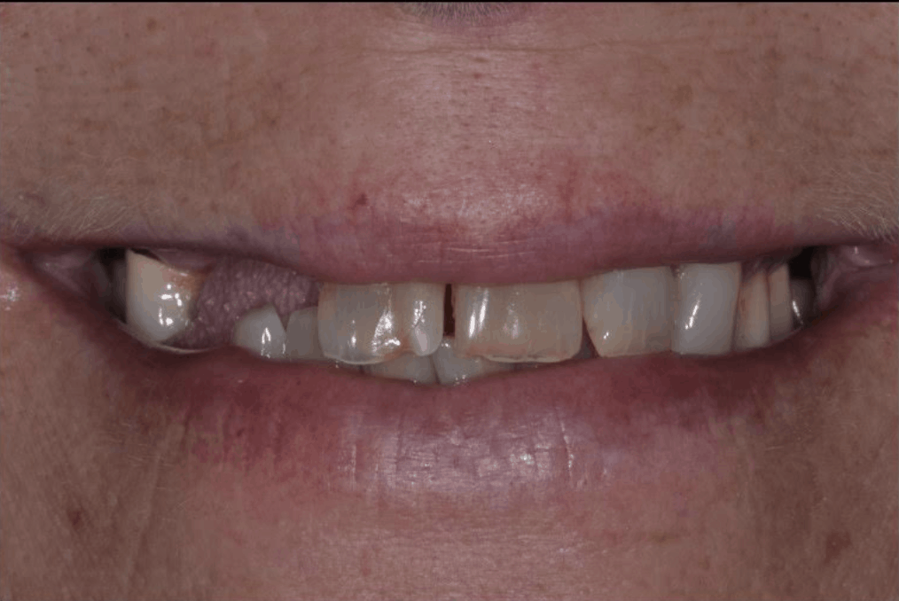 before dental implants danbury ct