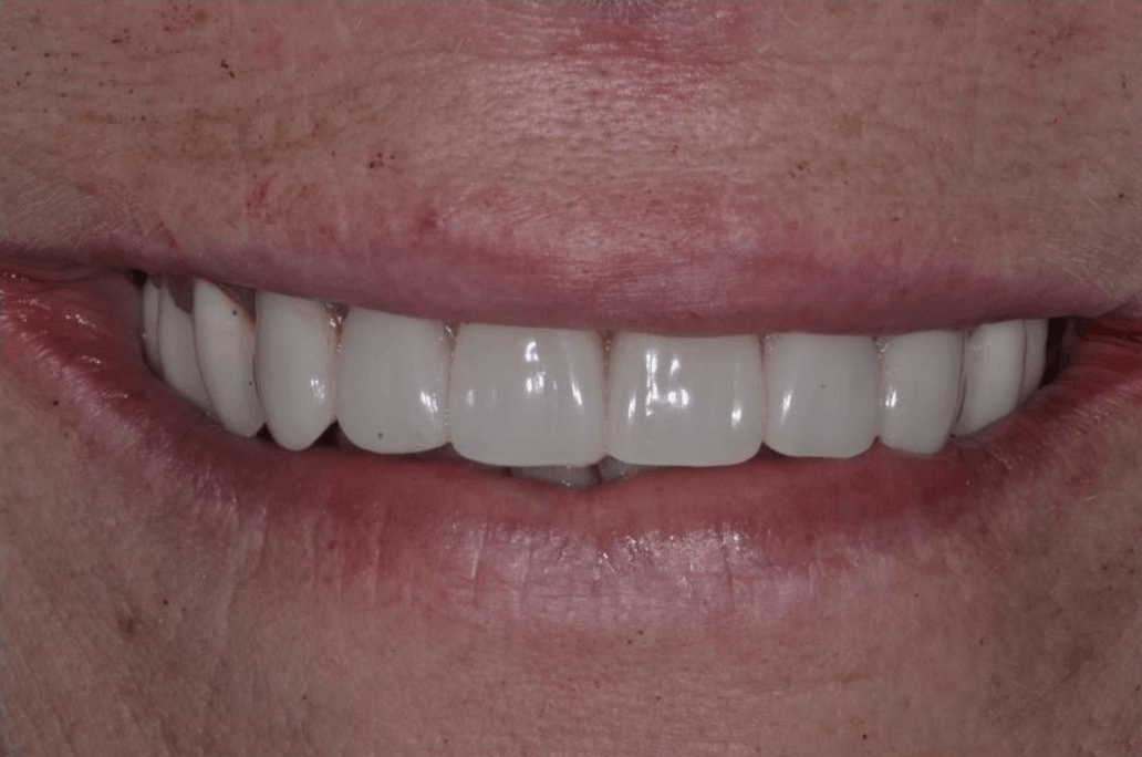 after dental implants danbury ct