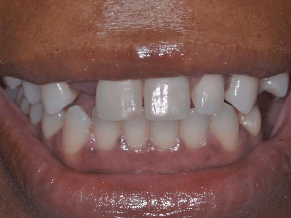 full smile dental implants ct