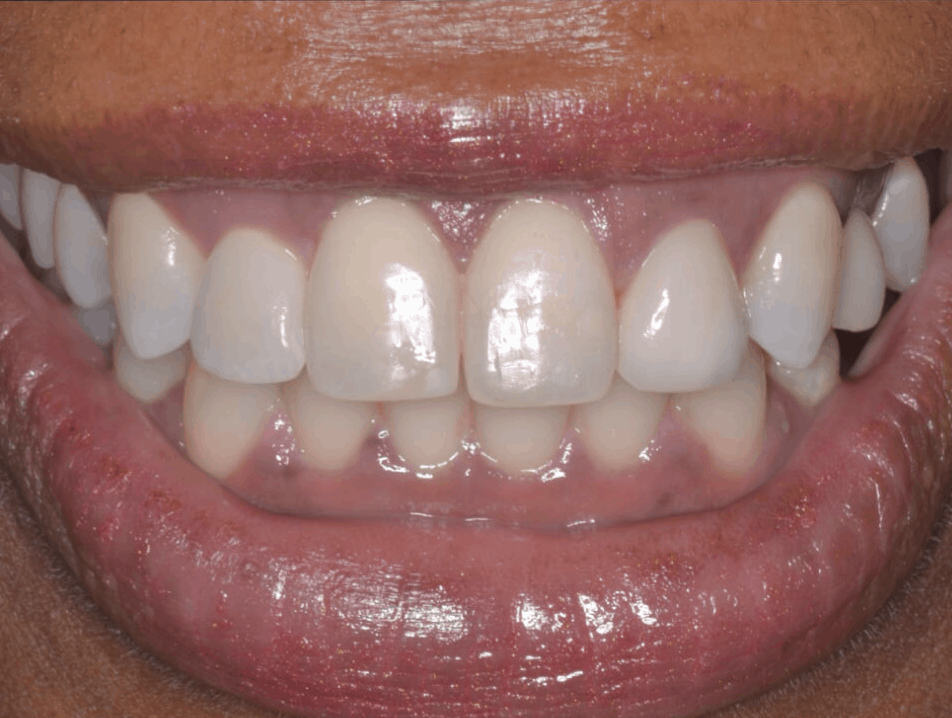 after full smile dental implants ct