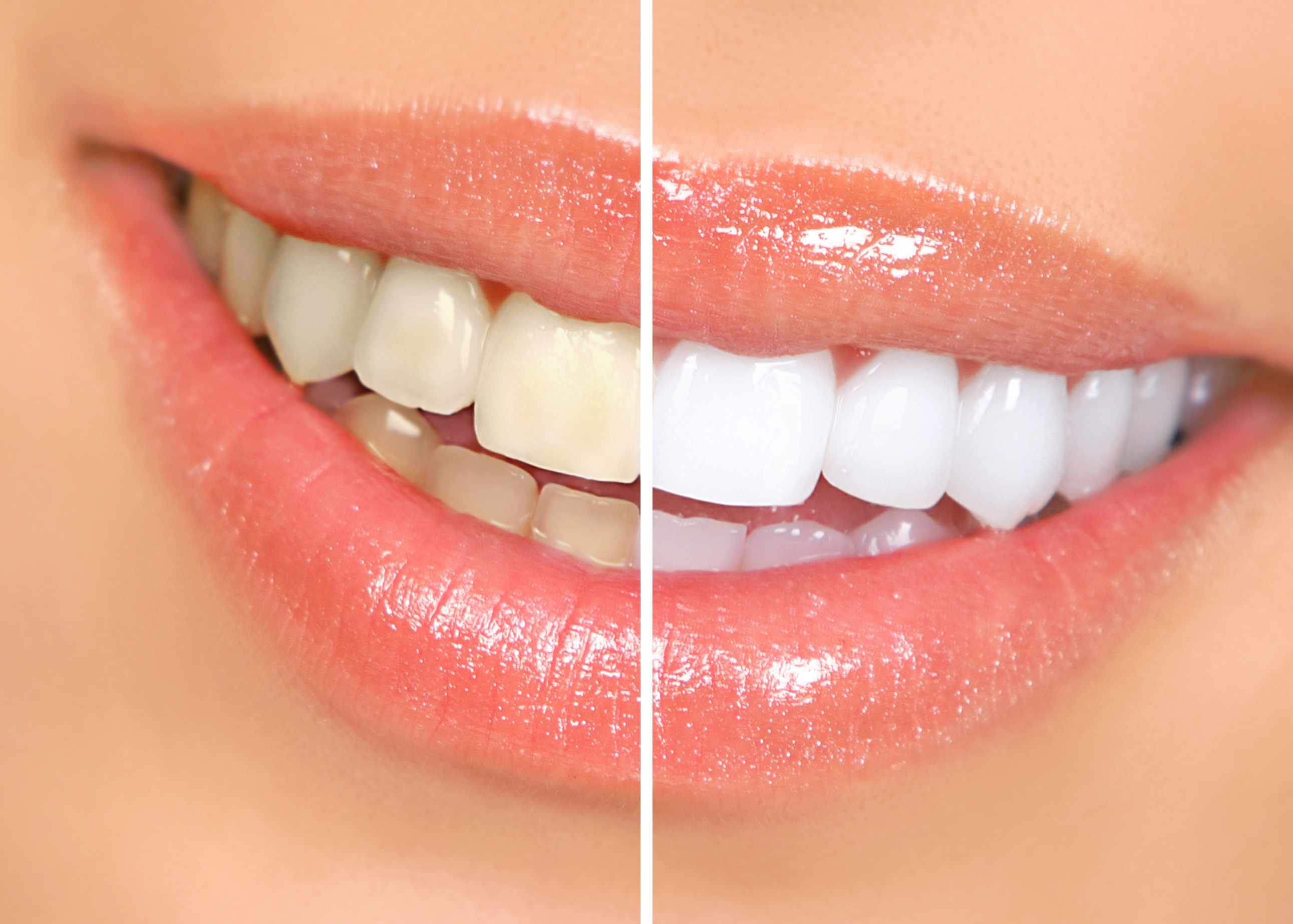 teeth whitening danbury