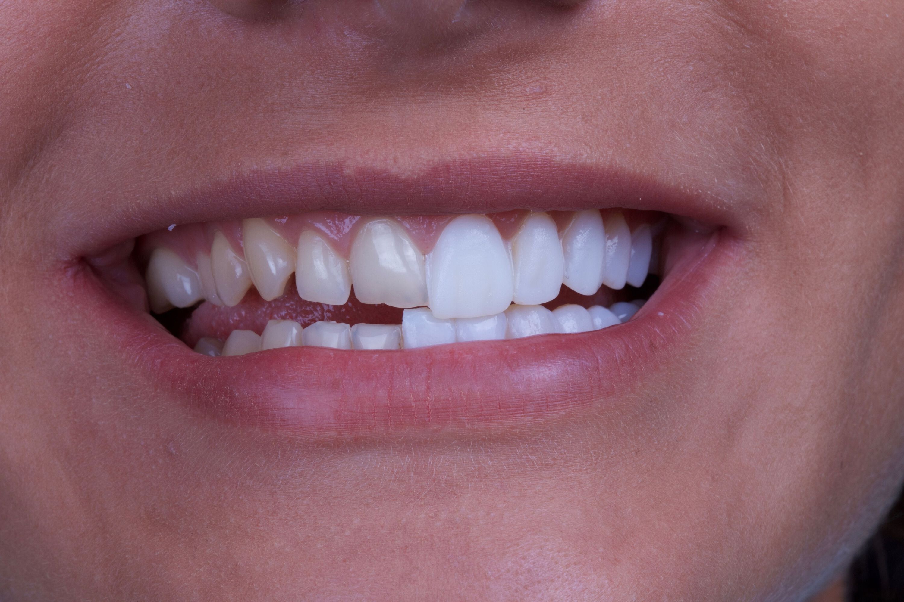 Are Dental Veneers Safe?  