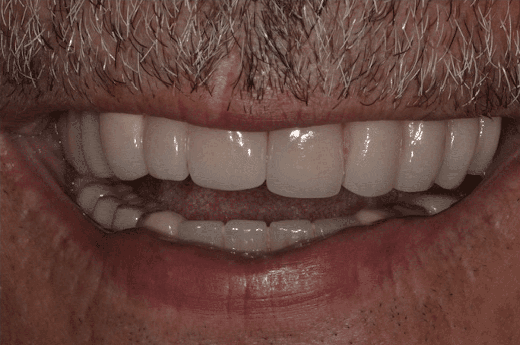 all on 4 dental implant