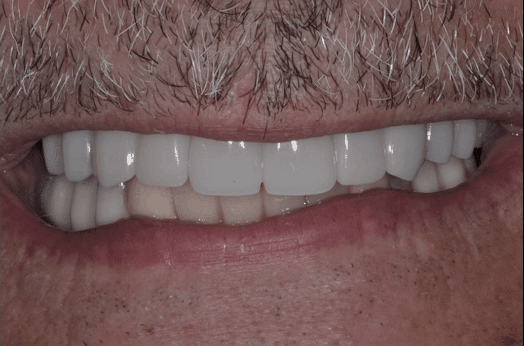 best dental implants after