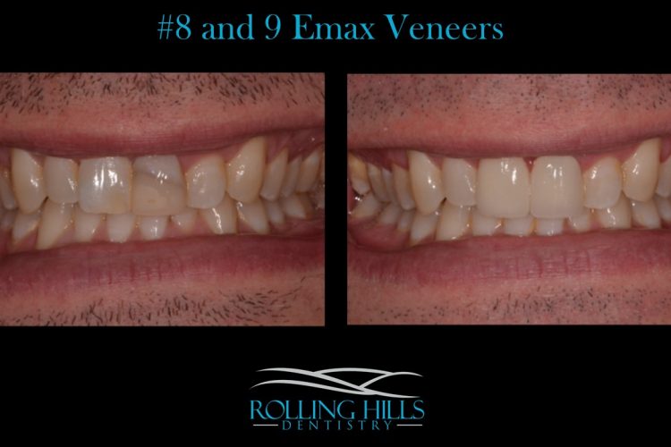 veneers danbury ct