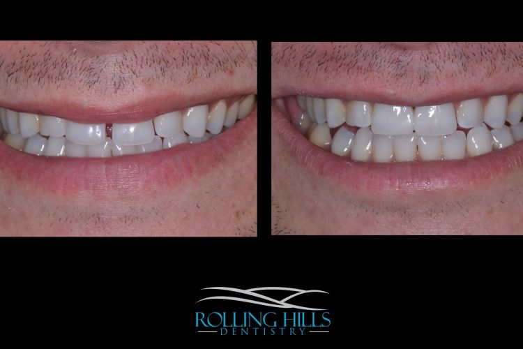 dental composite danbury