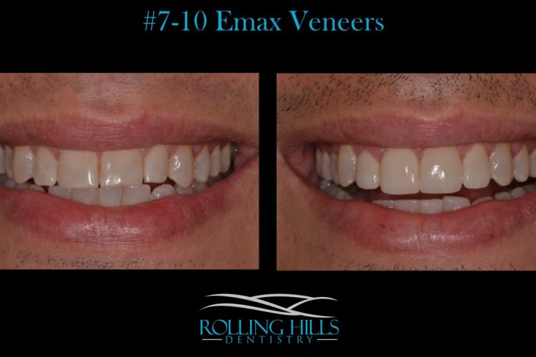 emax veneers danbury