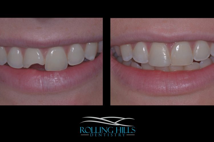 dental work danbury composite