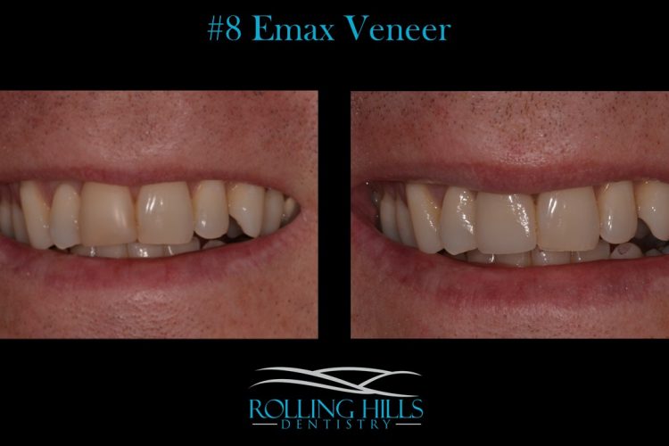 emax veneers danbury ct