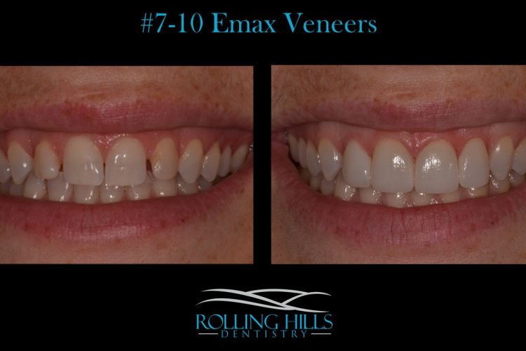emax veneers ct