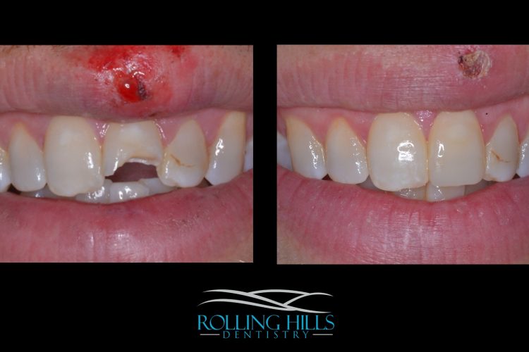 dental composites in danbury