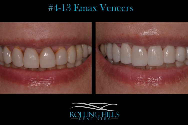 emax veneers 06810