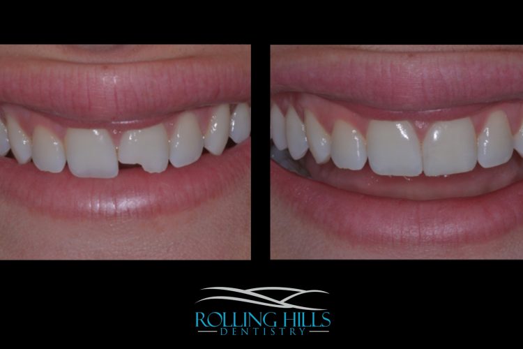 dental composites in danbury