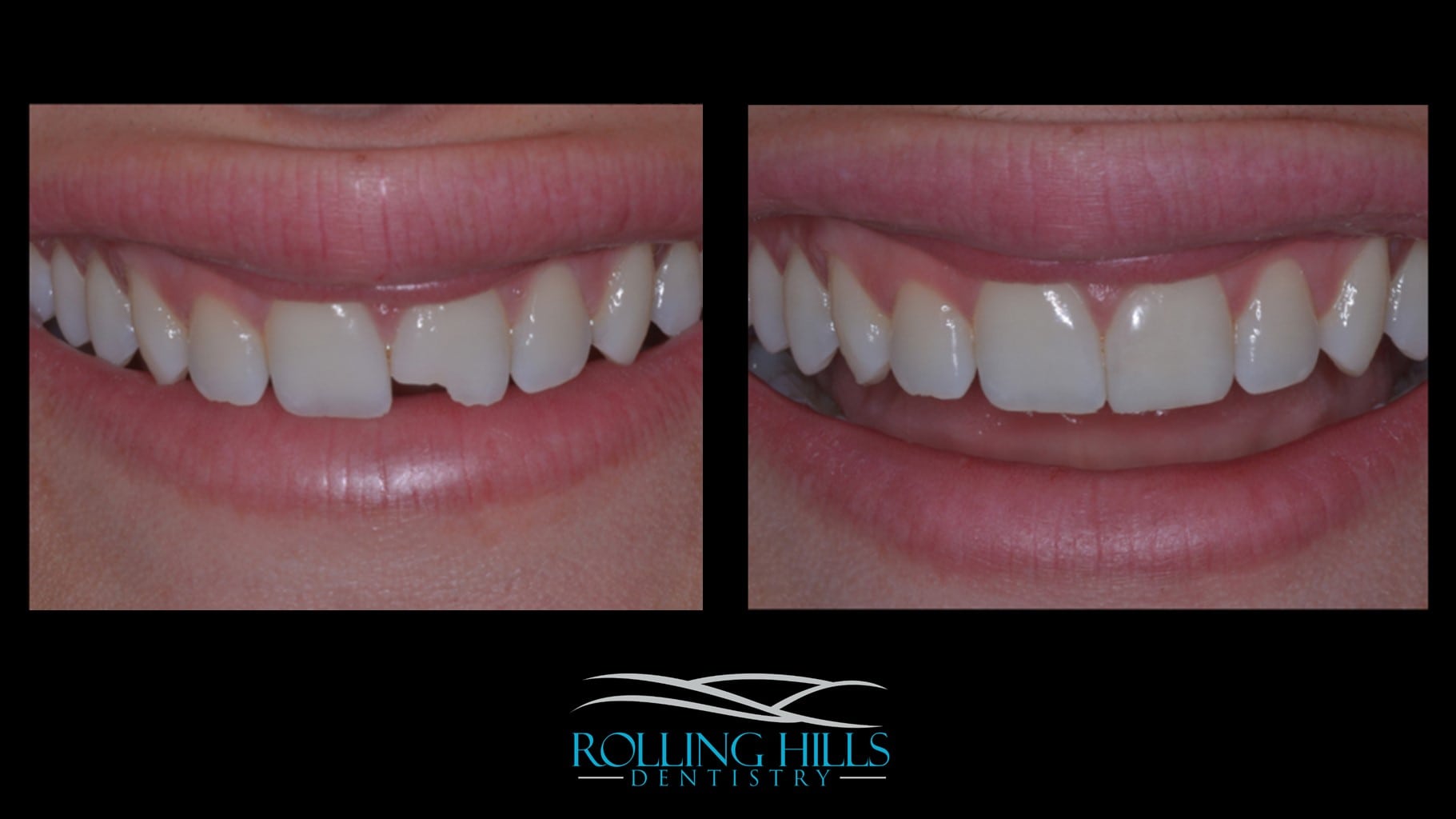 dental composites in danbury