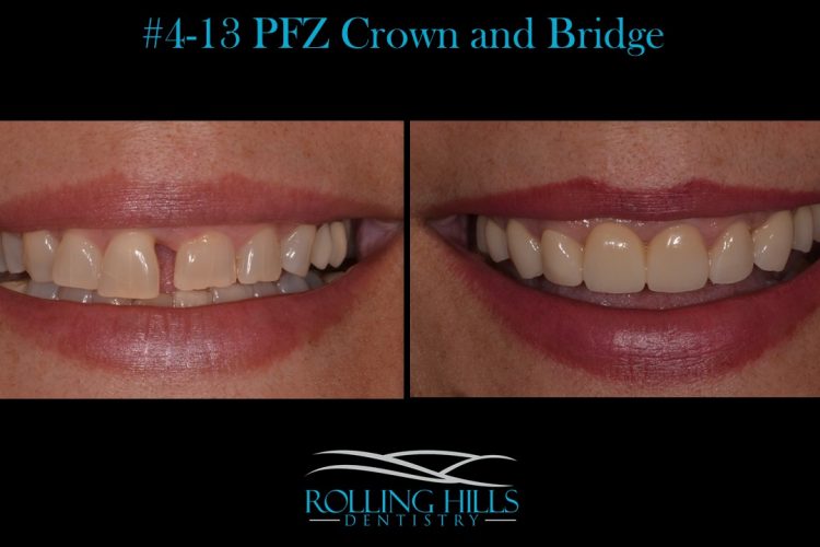 emax veneers danbury 06810