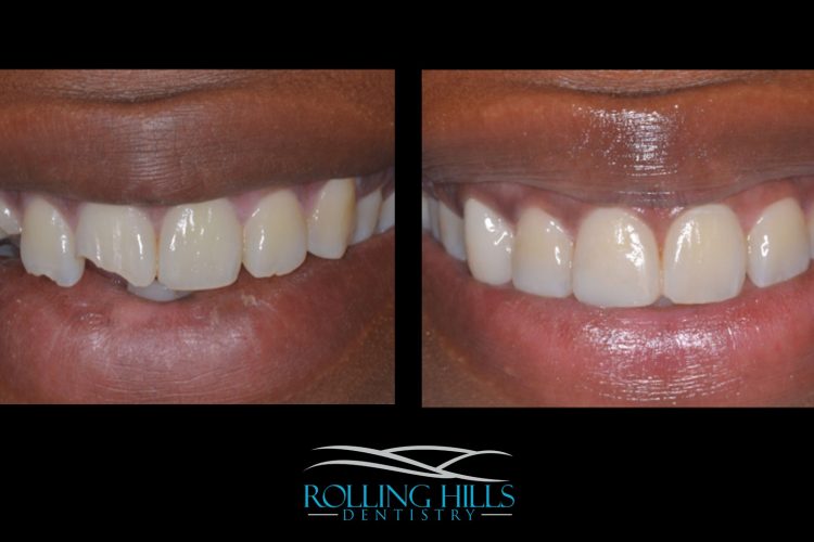 composite dental work danbury ct