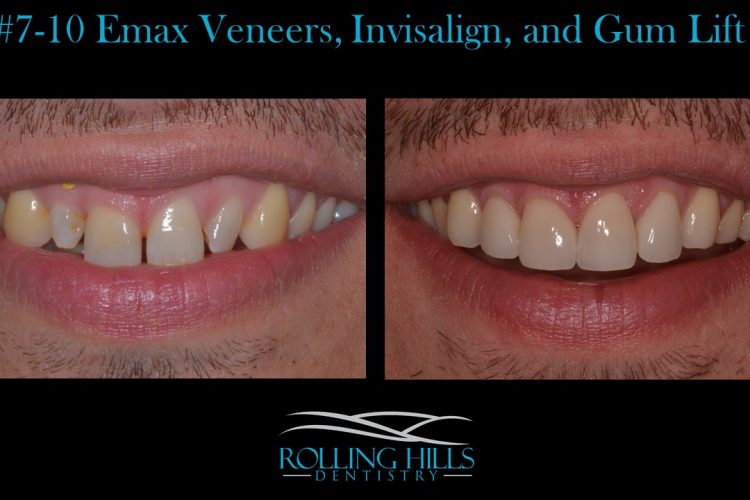 danbury dental veneers