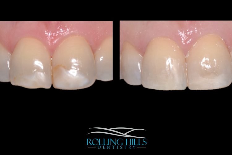 composite dental work