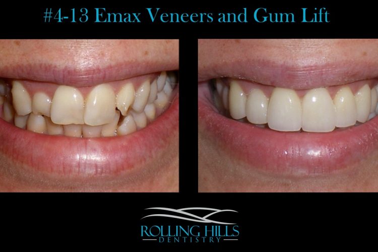veneers ct