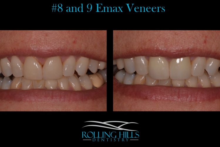 porcelain dental veneers