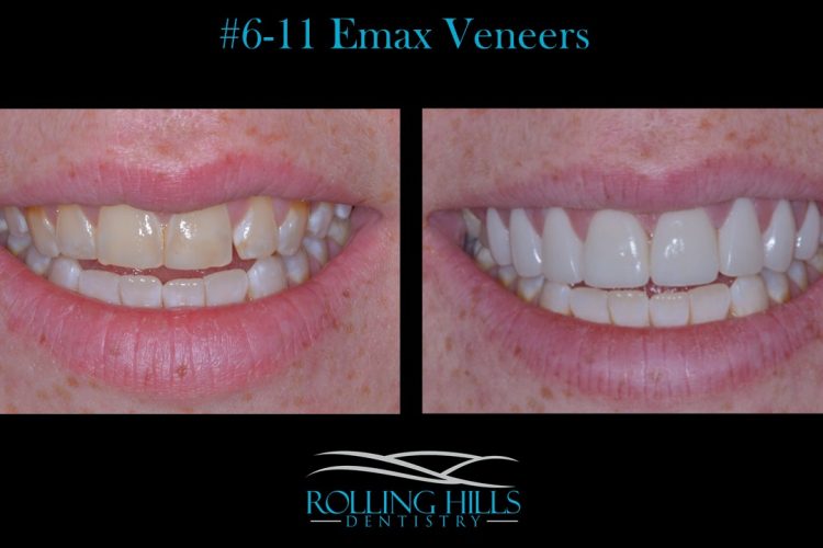 porcelain dental veneers danbury