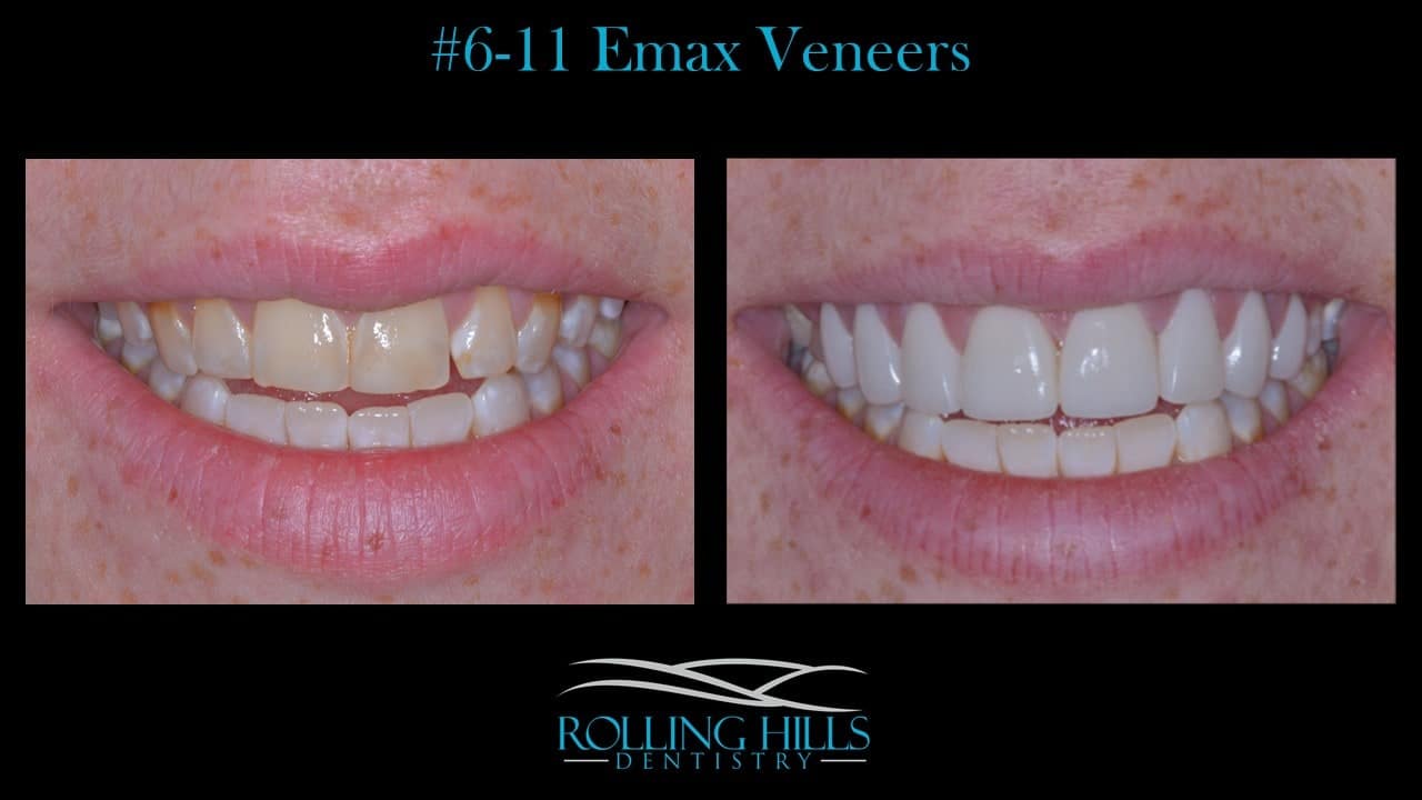 porcelain dental veneers danbury