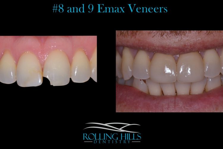 porcelain dental veneers ct
