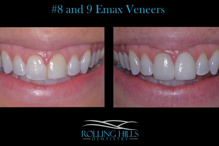 porcelain dental veneers danbury ct