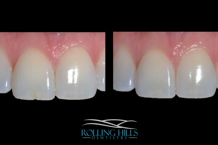 dental composites danbury
