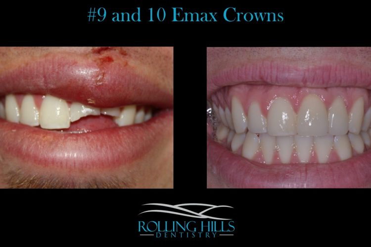 porcelain veneers danbury ct