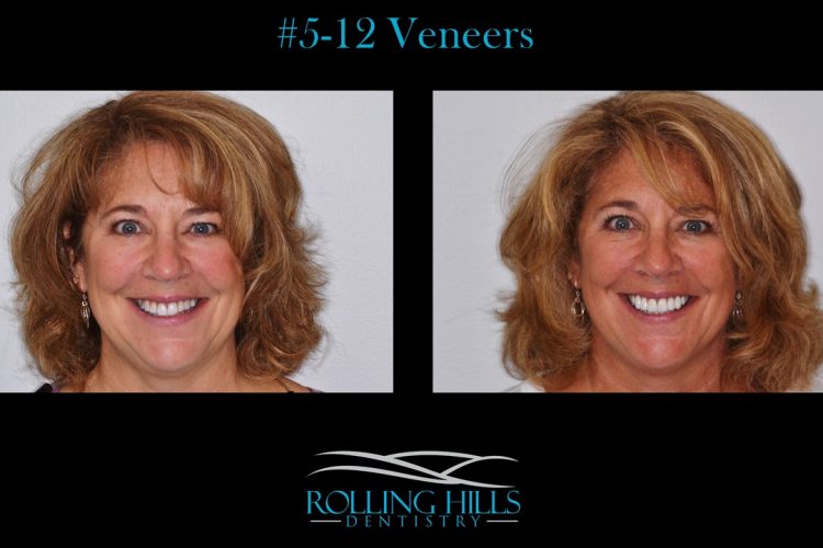 veneers