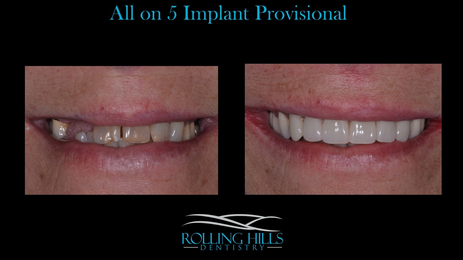 dental implants