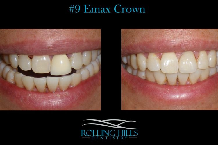 emax crown danbury ct
