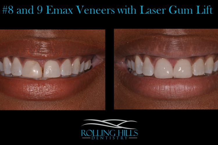 porcelain veneers ct