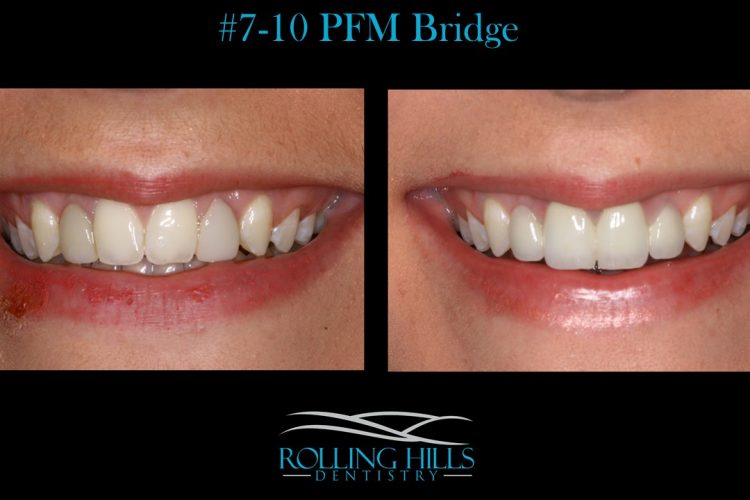 porcelain veneers