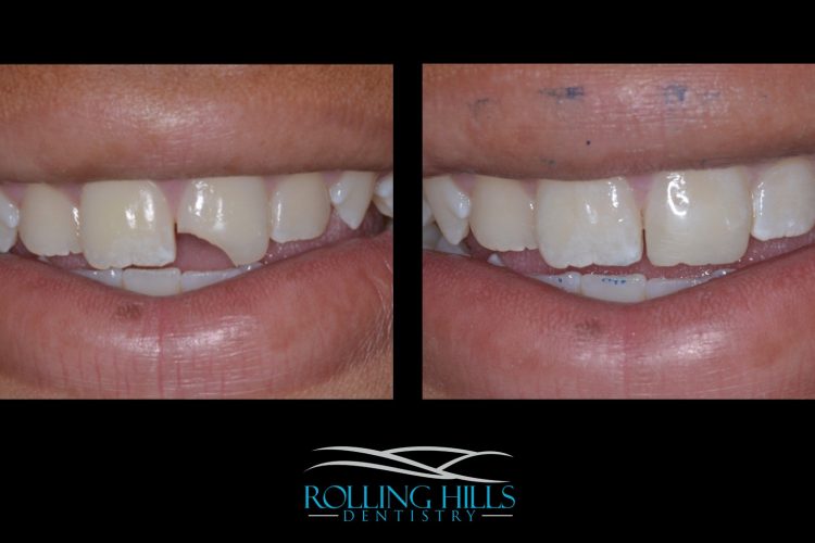 cosmetic composite dentist