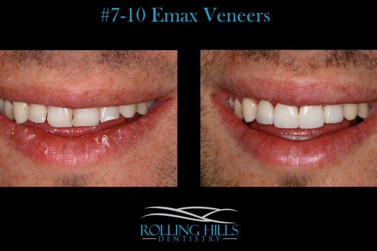 emax veneers