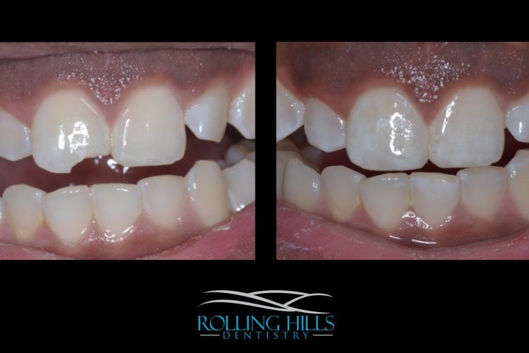 composite dentistry ct