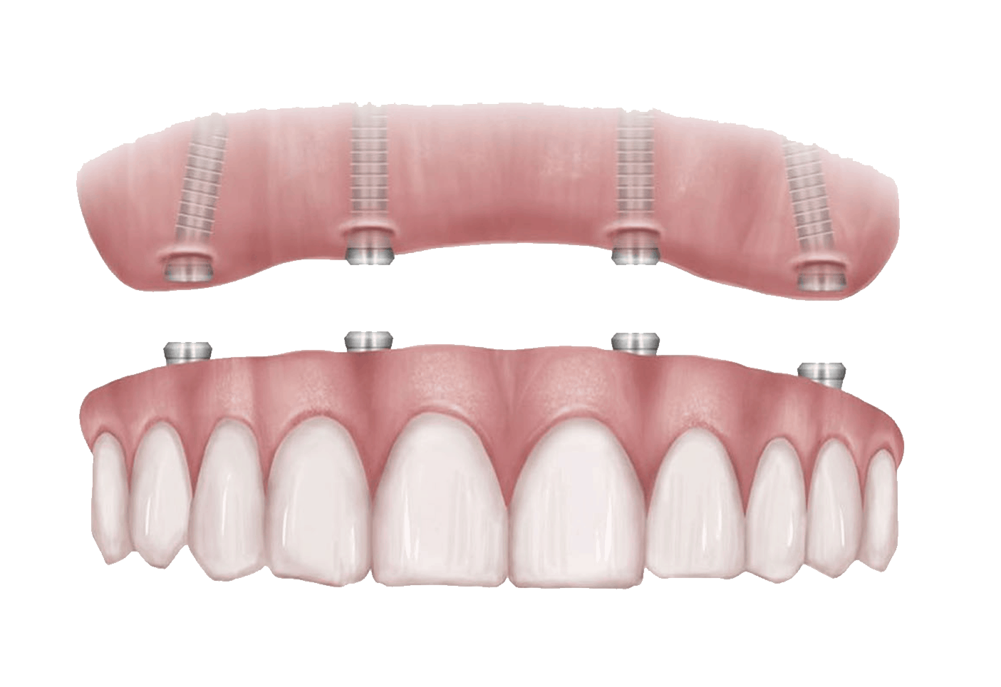 all on 4 dental implants