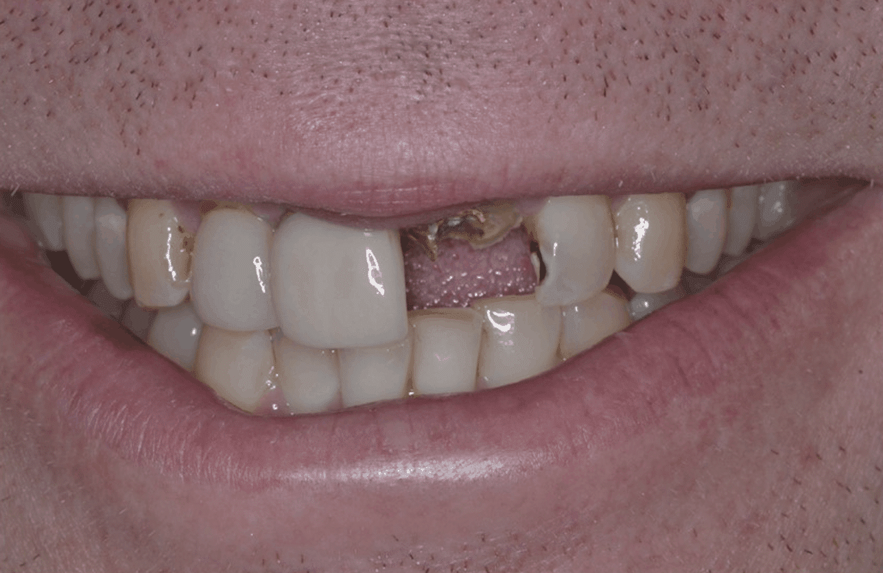 before dental implant