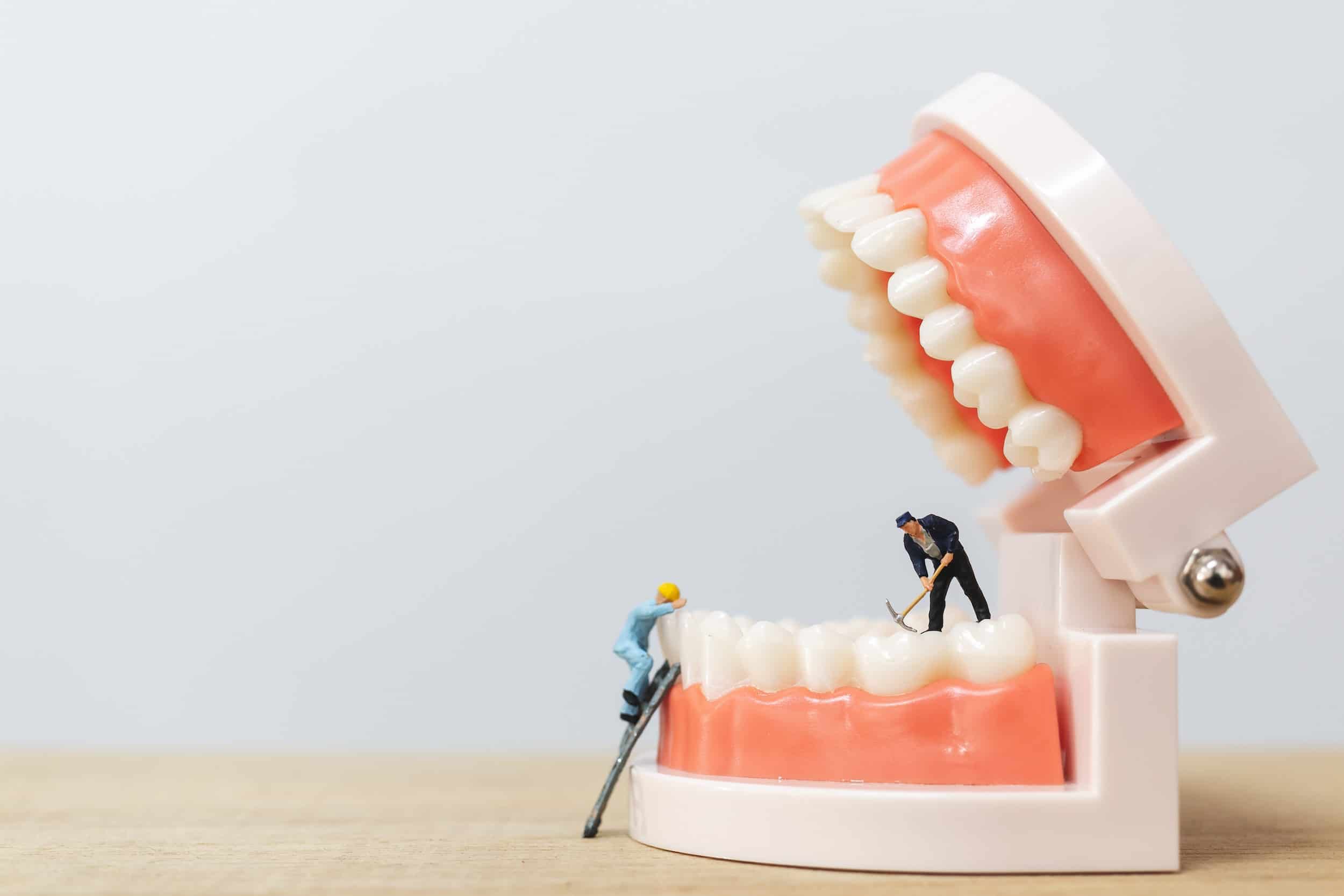 dental implants vs. dental veneers