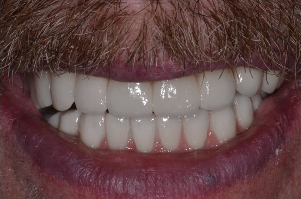 after dental implant restoration